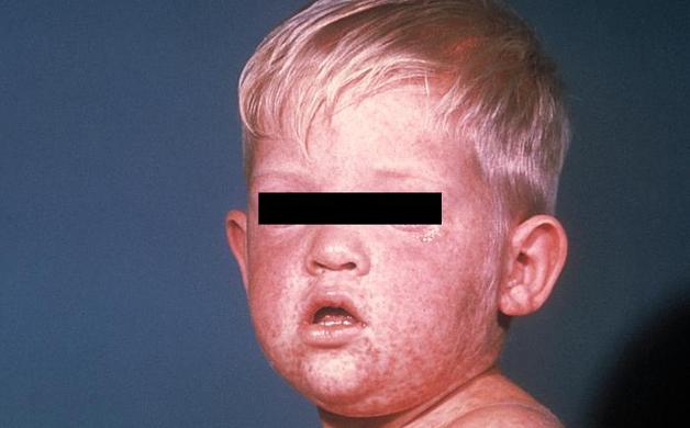 Four measles cases confirmed in Pasadena | Altadena Point