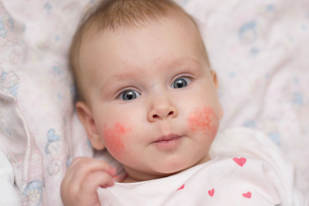 Common childhood rashes | Today's Family Magazine