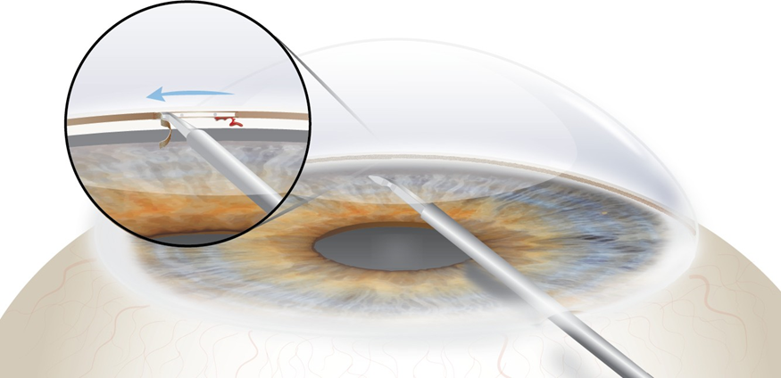 Glaucoma Treatment: GONIOTOMY Commonly Asked Questions | Franklin ...